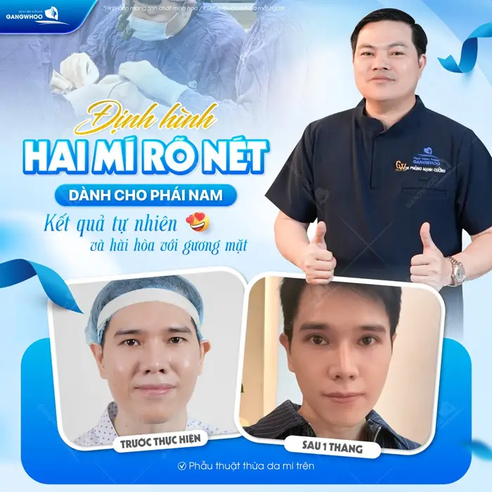 Định hình 2 mí rõ nét dành cho phái nam kết quả đẹp tự nhiên và hài hòa với gương mặt