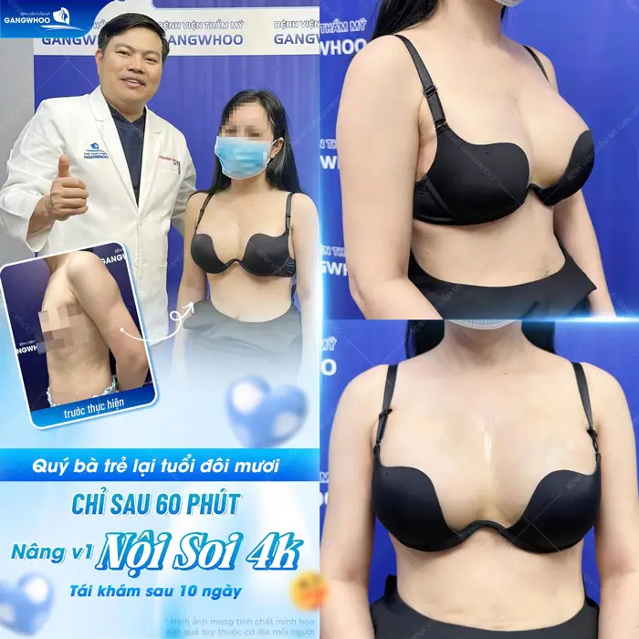Quý bà trẻ lại tuổi đôi mươi chỉ sau 60 phút nâng vòng 1 nội soi 4K tái khám sau 10 ngày kết quả đã hoàn toàn khác