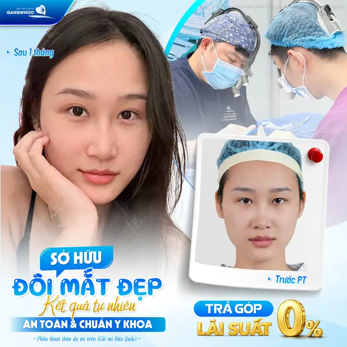 Sở hữu đôi mắt đẹp kết quả tự nhiên an toàn và đẹp chuẩn y khoa với lãi suất 0%