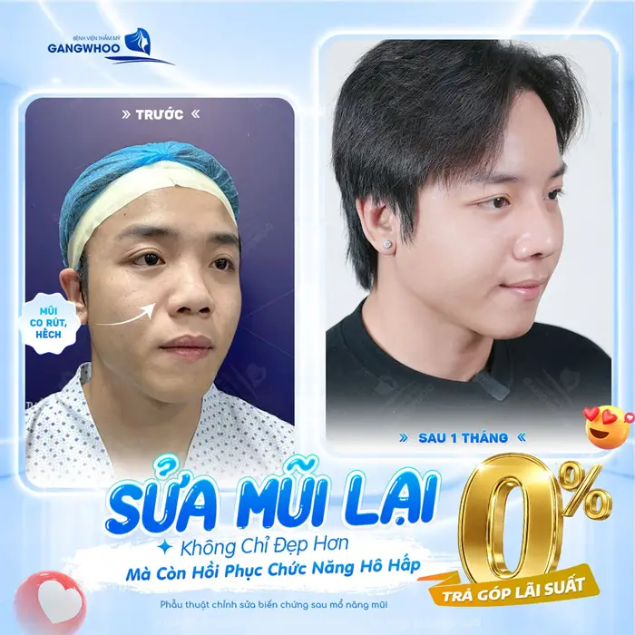 Sửa mũi lại không áp lực tài chính mũi cao đẹp hơn mà còn khôi phục chức năng hô hấp