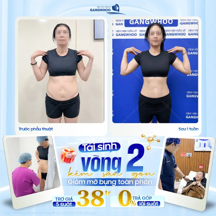 Top 5 Địa Chỉ Hút Mỡ Trả Góp Uy Tín Tại TPHCM 2 Tái sinh vòng 2 kém săn gọn giảm mỡ bụng toàn phần trả góp 0% lãi suất