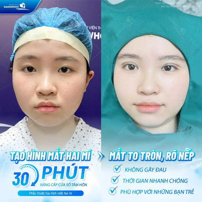 Tạo hình mắt 2 mí sau 30 phút đã tự tin khoe đôi mắt đẹp rạng rỡ, to tròn và đẹp rõ nếp