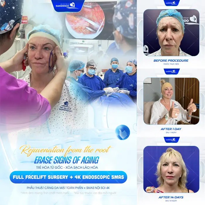 Trẻ hóa làn da an toàn xóa sạch lão hóa chỉ 1 lần phẫu thuật căng da mặt toàn phần Smas nội soi 4K đã hoàn toàn khác biệt