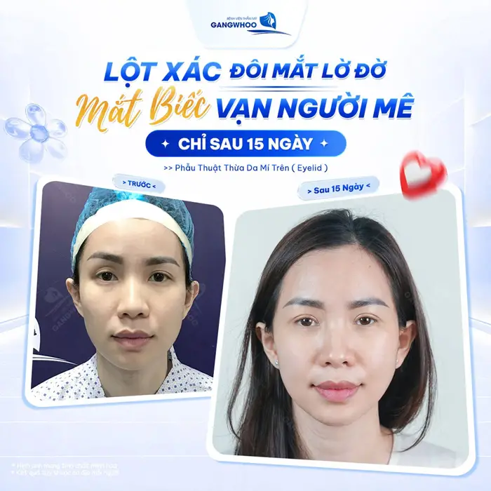 Có Nên Cắt Mí Trả Góp Không? Ưu Và Nhược Điểm Là Gì? 1 Từ mắt lờ đờ đến ánh mặt đẹp vạn người mê chỉ sau 15 ngày đã hoàn toàn khác biệt