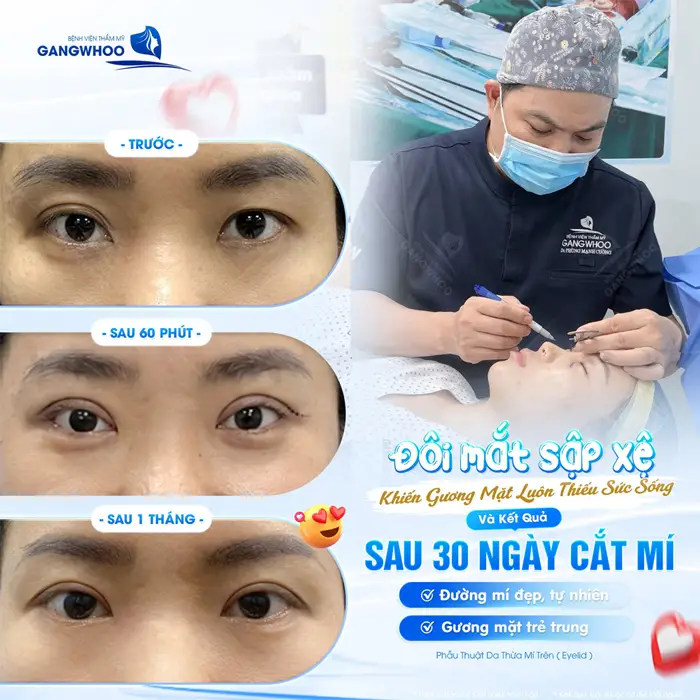 Cắt Mí Bao Lâu Thì Hết Sẹo? Cách Chăm Sóc Nhanh Hết Sẹo 3 Đôi mắt sập xệ khiến gương mặt luôn thiếu sức sống sau 30 ngày đường mí đẹp tự nhiên và trẻ trung