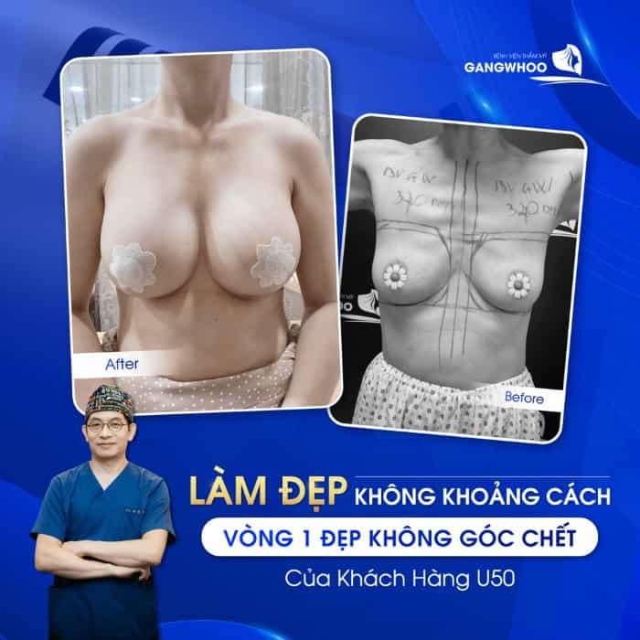 owning a sexy breast after breast augmentation at Gangwhoo Cosmetic Hospital