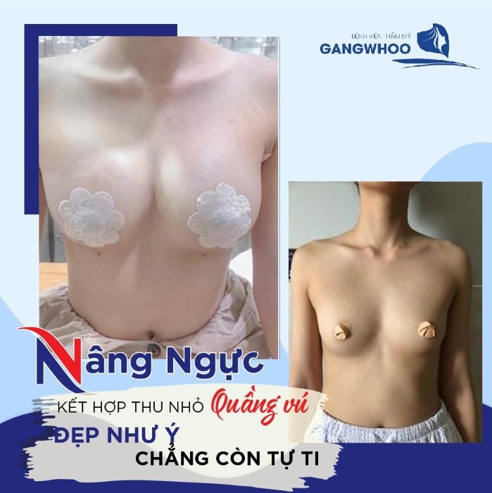 Khách Hàng Thực Hiện Nâng Ngực Không Cần Phẫu Thuật Hiệu Quả Tại "Gangwhoo"