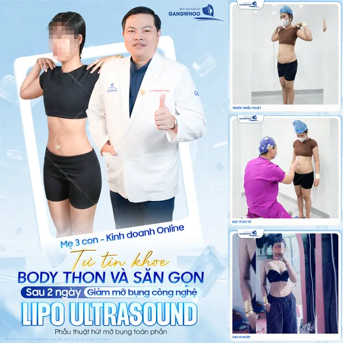Mẹ bỉm 3 con tự tin khoe body dẹp thon gọn và săn chắc sau 2 ngày giảm mỡ bụng công nghệ Lipo Ultrasound
