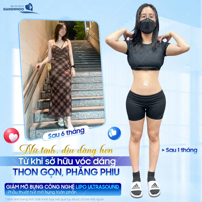 Nự tính, dịu dàng hơn từ khi sở hữu vóc dáng thon gọn, phẳng phiu sau giảm mỡ bụng công nghệ Lipo Ultrasound