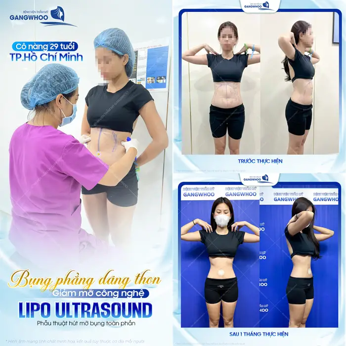 Bụng phẳng eo thon dáng gọn đẹp chuẩn mong đợi sau phẫu thuật hút mỡ công nghệ Lipo Ultrasound 