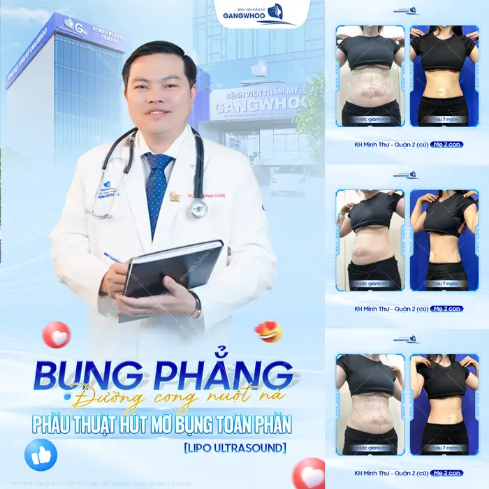 Bụng phẳng đường cong nuột nà phẫu thuật hút mỡ bụng toàn thân Lipo Ultrasound