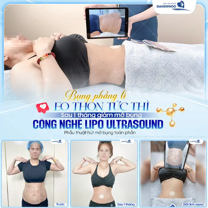 Bụng phẳng lì eo thon gọn tức thì sau 1 tháng giảm mỡ bụng với công nghệ Lipo Ultrasound hiện đại màn lột xác đã thay đổi thấy rõ