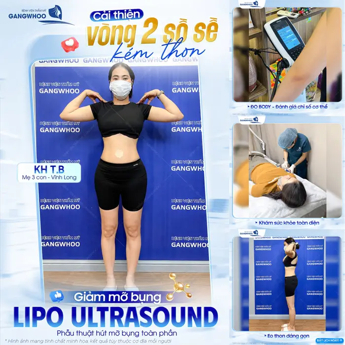 Cải thiện vòng 2 sồ sề kém thon sau giảm mỡ ứng dụng công nghệ Lipo ULtrasound tự tin khoe dáng đẹp xuất sắc