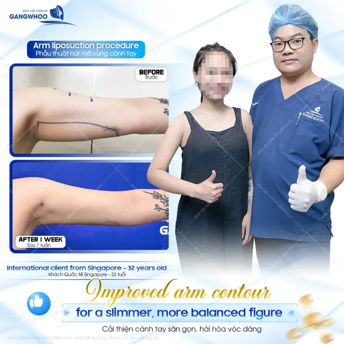 Cải thiện cánh tay săn gọn, hài hòa với vóc dáng chỉ sau 1 tuần thực hiện đôi tay đã đẹp hơn thấy rõ