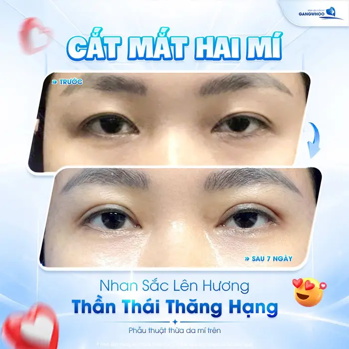 Cắt mắt 2 mí nhan sắc lên hương thần thái thăng hạng 