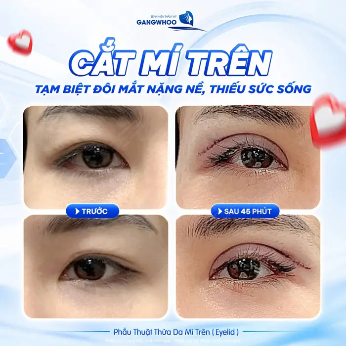 Cắt mí trên tạm biệt đôi mắt nặng nề, thiếu sức sống với đường mí đẹp mềm mại  và tự nhiên