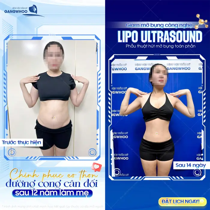 Chinh phục eo thon đường cong cân đối sau 12 năm làm mẹ nhờ giảm mỡ Lipo Ultrasound