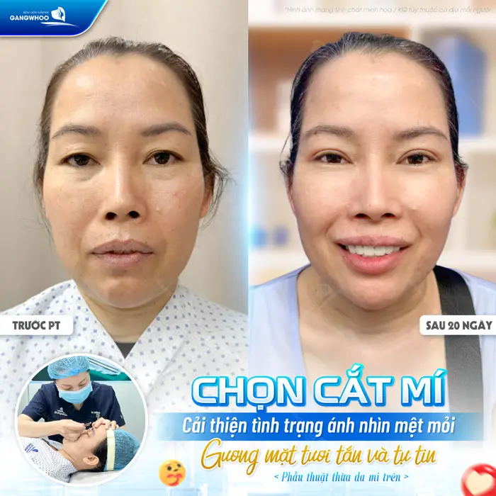 Chọn cắt mí cải thiện ánh nhìn mệt mỏi gương mặt thêm tươi tắn và đẹp tràn đầy tự tin