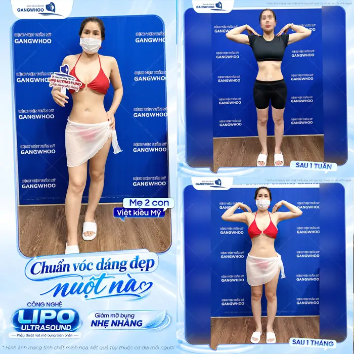 Chuẩn dáng đẹp nuột nà sau hút mỡ ứng dụng công nghệ hiện đại Lipo Ultrasound 