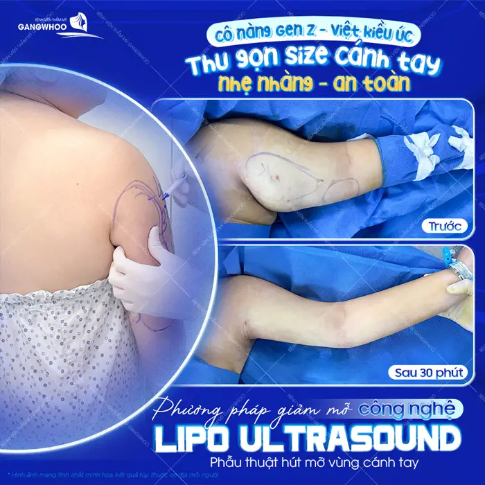 Thu gọn size cánh tay nhẹ nhàng và an toàn phương pháp giảm mỡ công nghệ Lipo Ultrasound