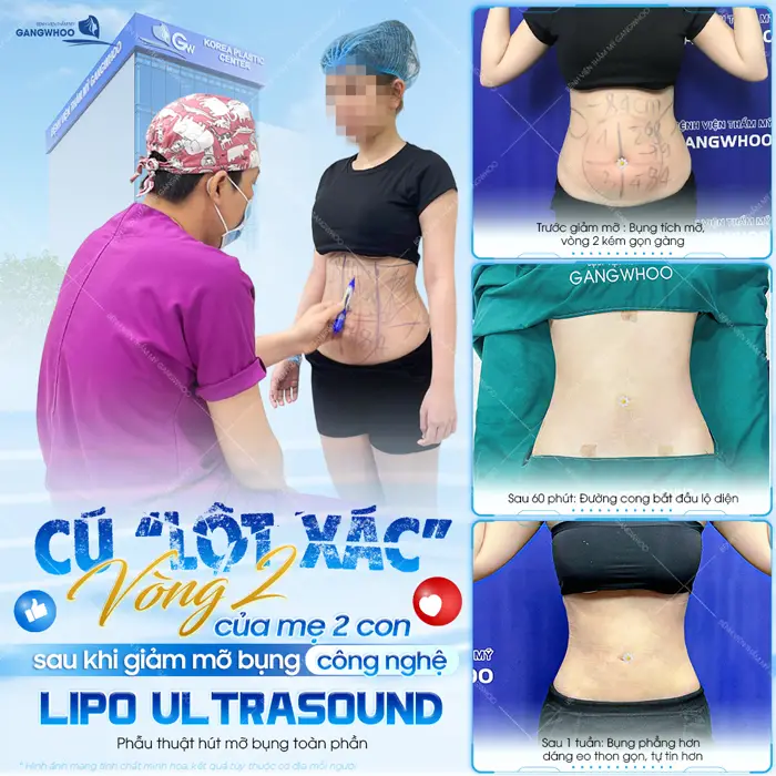 "Lột xác" vòng 2 của mẹ 2 con sau khi giảm mỡ bụng công nghệ Lipo Ultrasound bụng phẳng nuột eo thon gọn đẹp thấy rõ