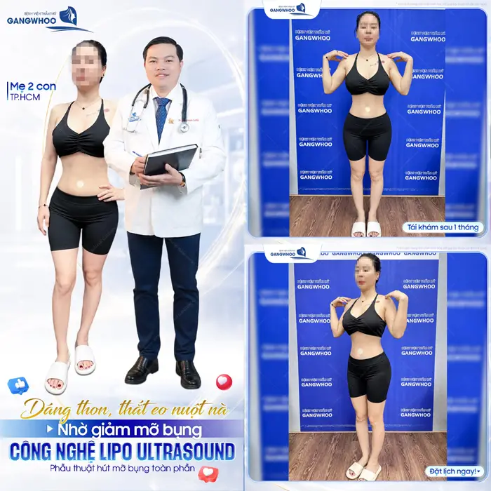 Dáng thon, thắt eo nuột nà nhờ giảm mỡ bụng công nghệ Lipo Ultrasound  kết quả sau 1 tháng đẹp chấn động