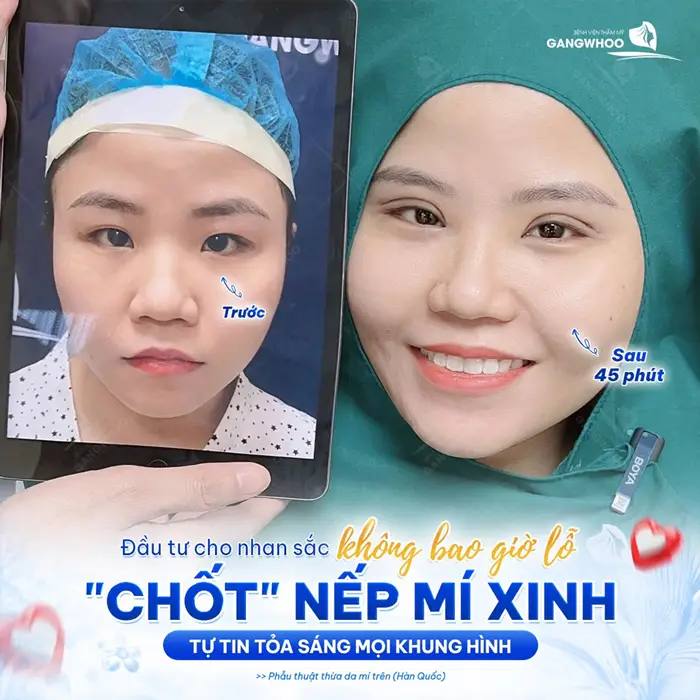 Cắt Mí Rồi Có Cắt Lại Được Không? Địa Chỉ Cắt Mí Lần 2 4 Đầu tư cho nhan sắc không bao giờ lỗ tự tin khoe nếp mí xinh tự tin tỏa sáng mọi khung hình