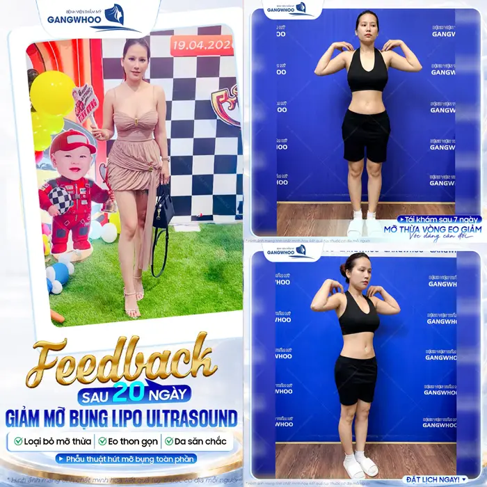 Feedback sau 20 ngày giảm mỡ bụng Lipo Ultrasound loại bỏ mỡ thừa tự tin khoe eo thon gọn đẹp xuất sắc 