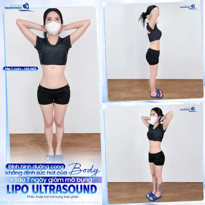 Định hình đường cong khẳng định sức hút cho body đẹp chuẩn tỷ lệ sau hút mỡ ứng dụng công nghệ Lipo Ultrasound