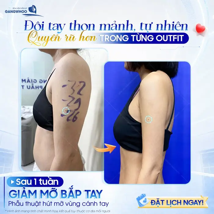 Đôi tay thon mảnh và đẹp tự nhiên sau 1 tuần giảm mỡ bắp tay tự tin khoe cánh tay thon nuột, mảnh khảnh