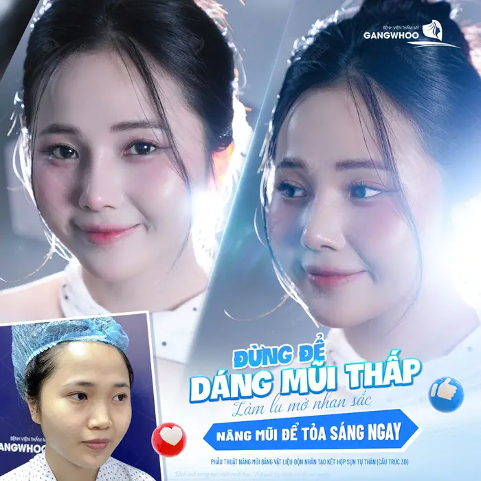 Nâng mũi để tỏa sáng không còn tự ti vì dáng mũi thấp tẹt mang nhiều khiếm khuyết