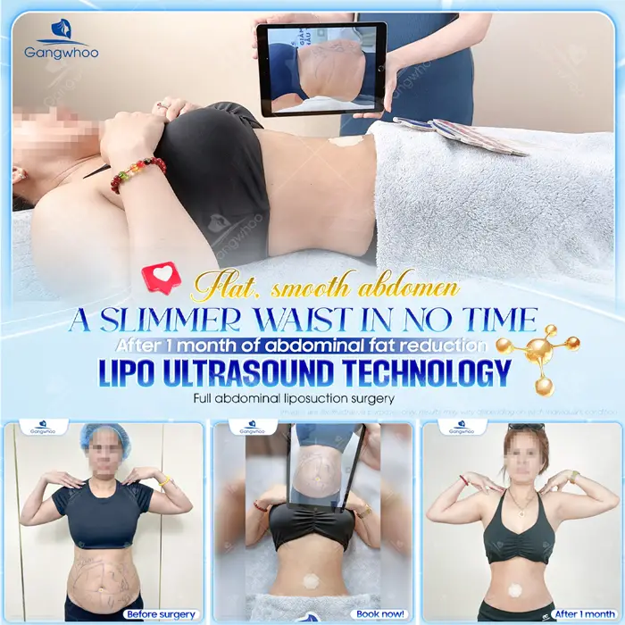 Top 10 Cosmetic Facilities For Safe Abdominal Liposuction in HCM City 6 en dia chi hut mo bung an toan 1