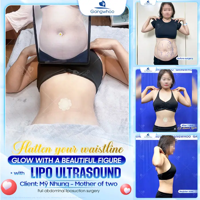 Top 10 Cosmetic Facilities For Safe Abdominal Liposuction in HCM City 5 en dia chi hut mo bung an toan 10