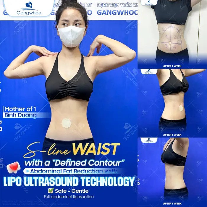 Top 10 Cosmetic Facilities For Safe Abdominal Liposuction in HCM City 8 en dia chi hut mo bung an toan 2