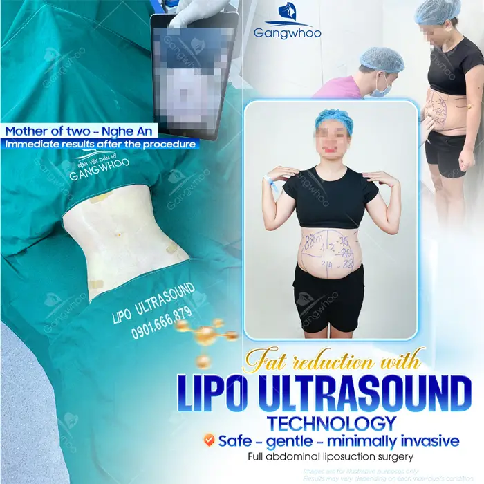 Top 10 Cosmetic Facilities For Safe Abdominal Liposuction in HCM City 9 en dia chi hut mo bung an toan 3