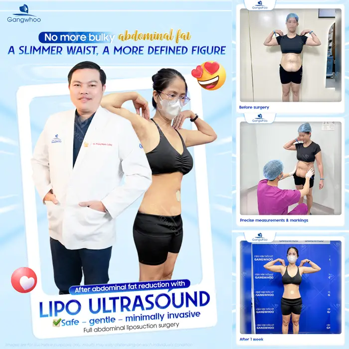 Top 10 Cosmetic Facilities For Safe Abdominal Liposuction in HCM City 4 en dia chi hut mo bung an toan 5