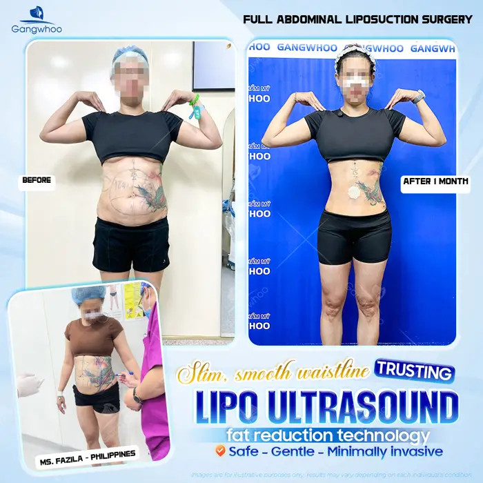 Top 10 Cosmetic Facilities For Safe Abdominal Liposuction in HCM City 10 en dia chi hut mo bung an toan 6