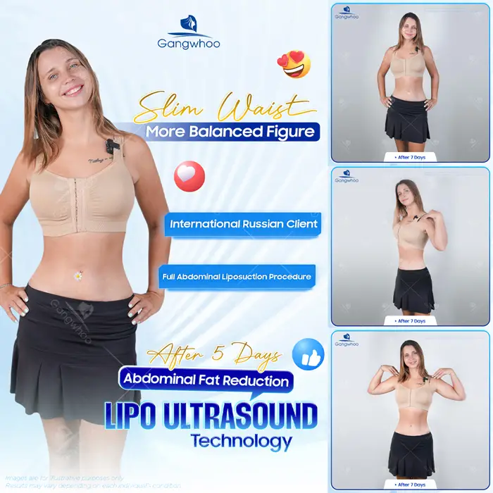 Top 10 Cosmetic Facilities For Safe Abdominal Liposuction in HCM City 7 en dia chi hut mo bung an toan 7