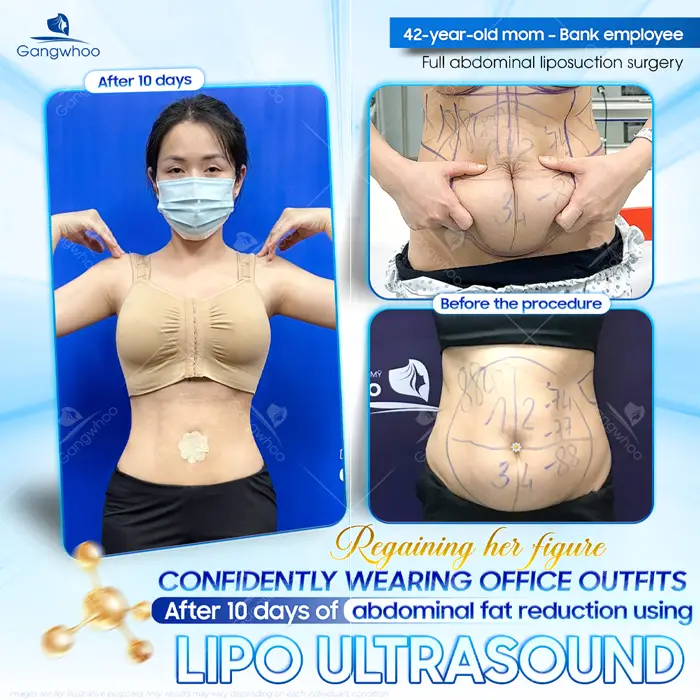 Top 10 Cosmetic Facilities For Safe Abdominal Liposuction in HCM City 1 en dia chi hut mo bung an toan 8