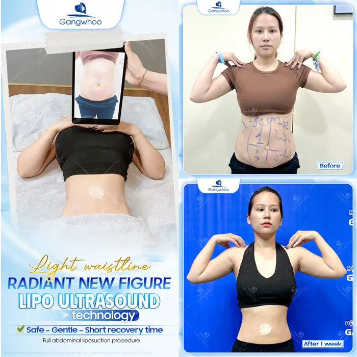 Top 10 Cosmetic Facilities For Safe Abdominal Liposuction in HCM City 2 en dia chi hut mo bung an toan 9
