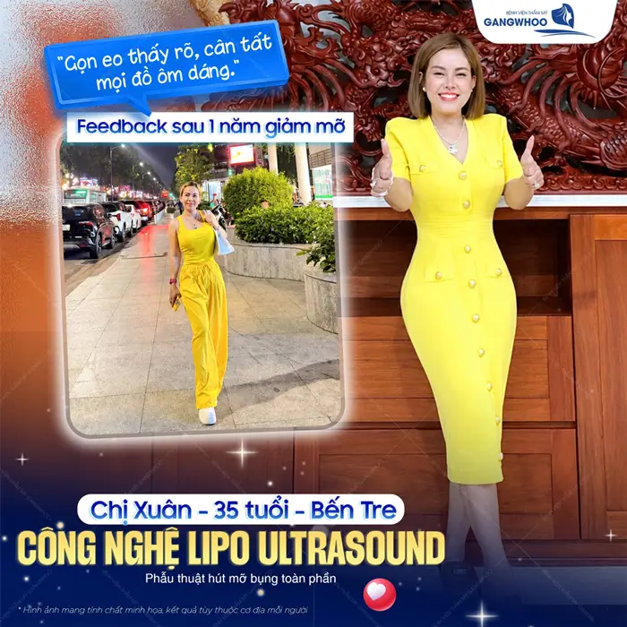 Hút mỡ bụng công nghệ Lipo Ultrasound sau 35 tuổi tự tin khoe dáng nuột nà