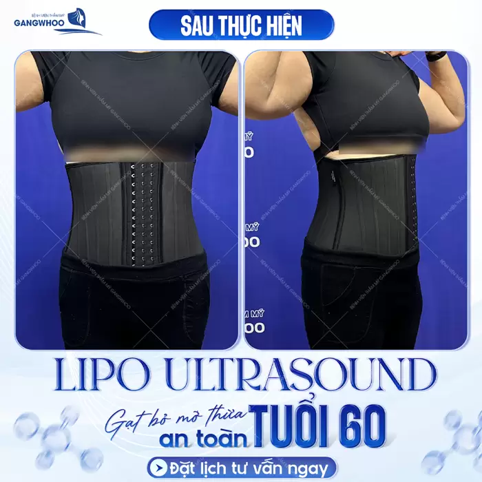 gat bo mo thua tuoi 60 hieu qua bang cong nghe lipo ultrasound 2