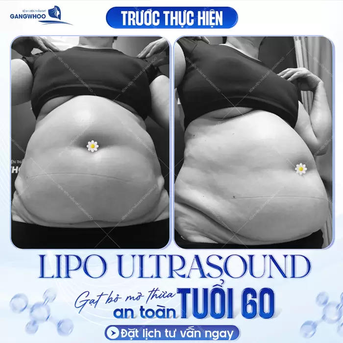 gat bo mo thua tuoi 60 hieu qua bang cong nghe lipo ultrasound
