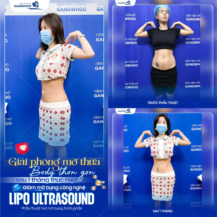 Giải phóng mỡ thừa body đẹp thon gọn không sưng đau, không khó chịu nhanh hồi phục và đẹp chuẩn dáng 