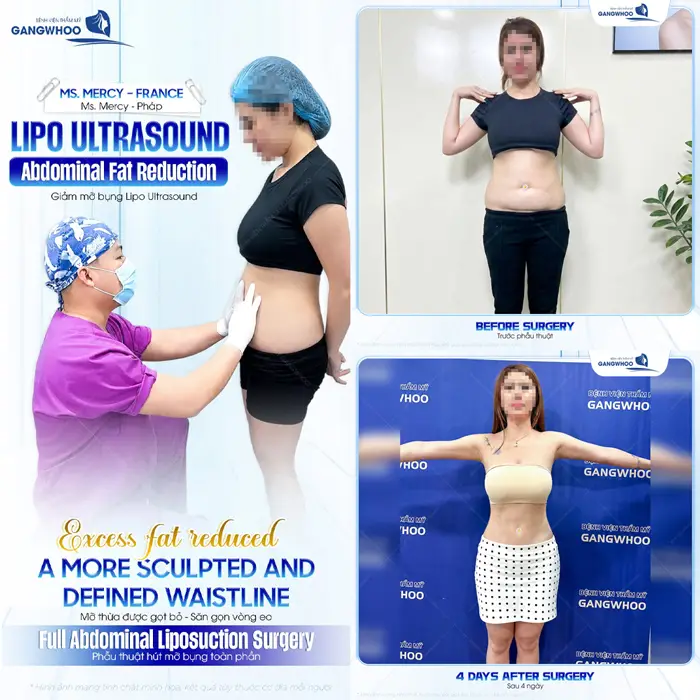 Phẫu thuật giảmmỡ bụng Lipo Ultrasound mỡ thừa được gạt bỏ tự tin sở hữu body đẹp xuất sắc
