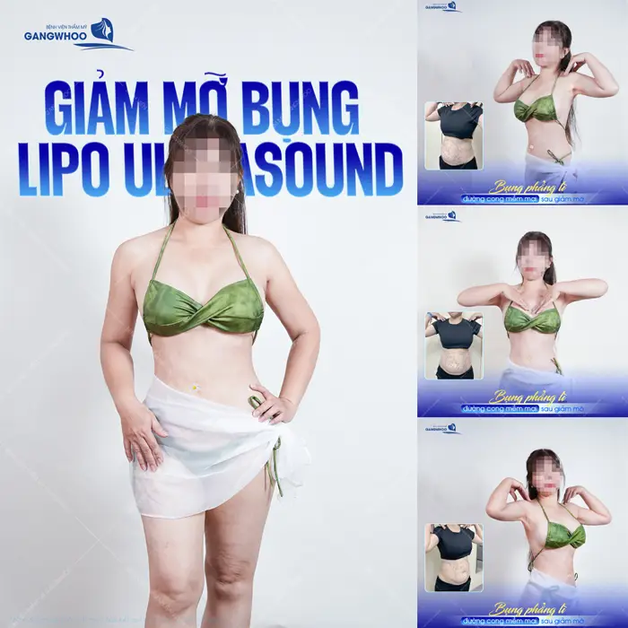 Giảm mỡ bụng (Lipo Ultrasound) bụng phẳng eo thon tự tin với vóc dáng thon đẹp nuột nà