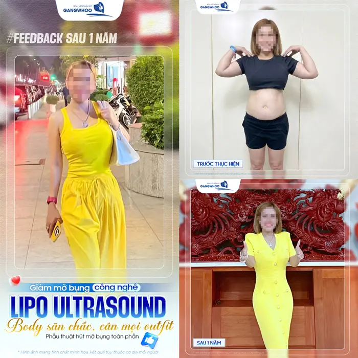 Giảm mỡ bụng công nghệ Lipo Ultrasound body săn chắc, cân mọi outfit