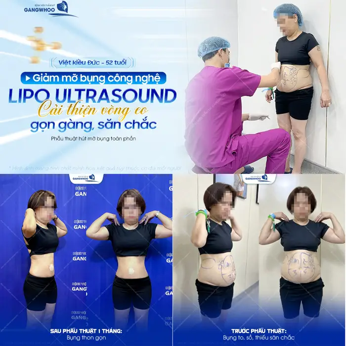Giảm mỡ bụng công nghệ Lipo Ultrasound cải thiện vòng eo đẹp gọn gàng và săn chắc