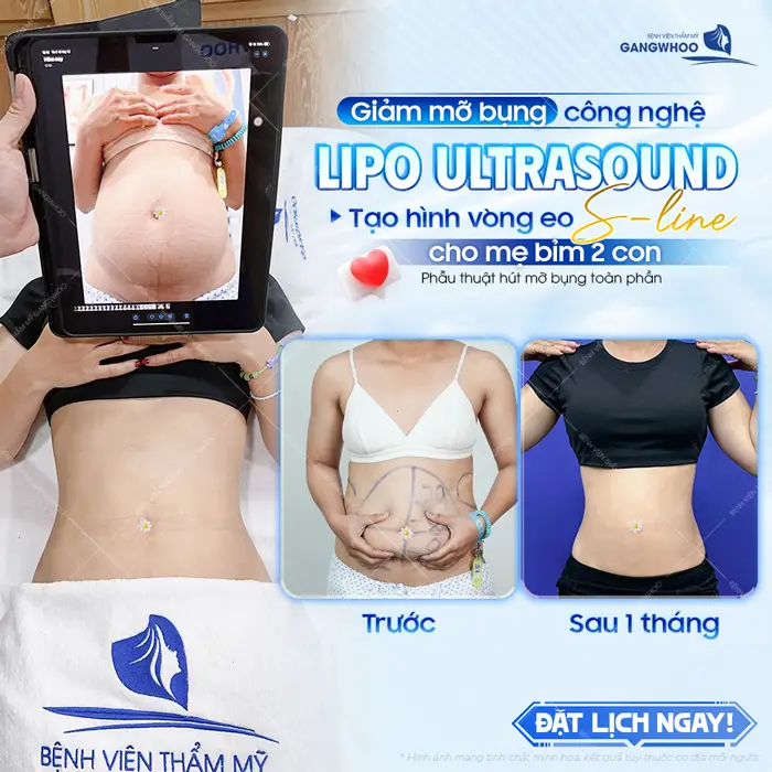 Giảm mỡ bụng công nghệ Lipo Ultrasound tạo hình vòng eo S Line cho mẹ bỉm 2 con sau 1 tháng đã đẹp hơn thấy rõ