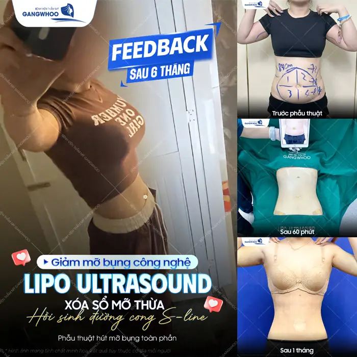 Giảm mỡ bụng công nghệ Lipo Ultrasound xóa sổ mỡ thừa hồi sinh đường cong S Line đẹp hoàn hảo 